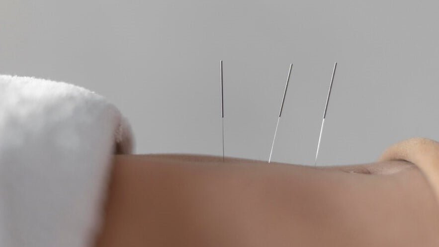 acupuncture eft 1